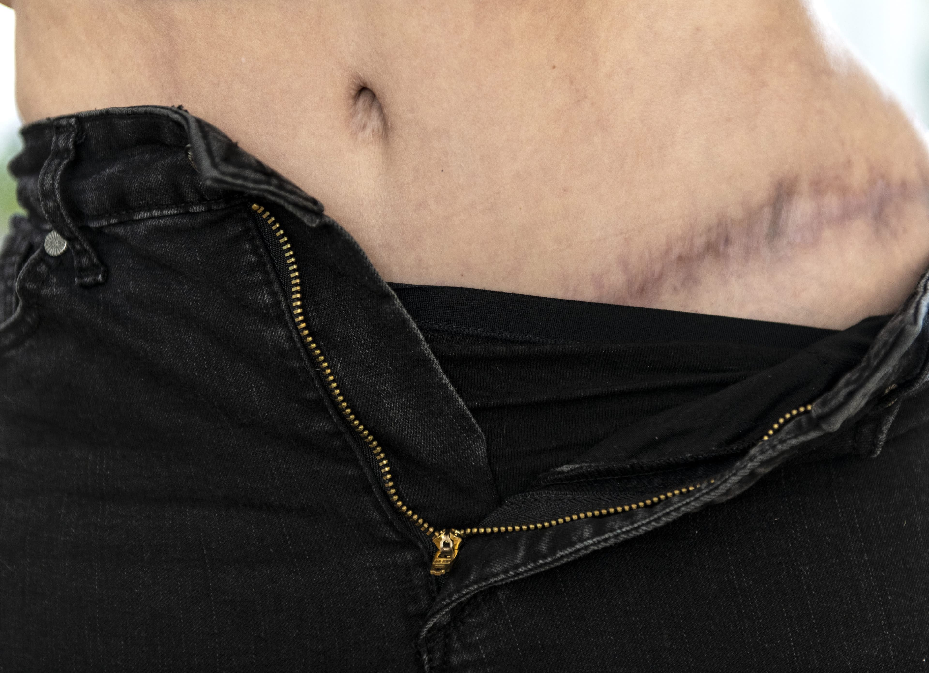 Cette femme dans la quarantaine a bien cru mourir en septembre dernier, quelques semaines avoir après avoir développé une infection après une chirurgie esthétique. Voici une des cicatrices post-opératoires.