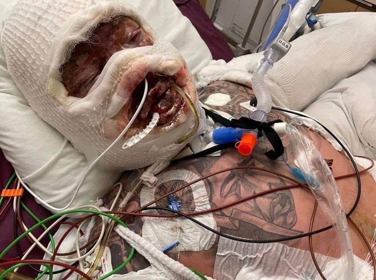 Olivier Marchand a passé trois mois dans le coma après l'incendie.