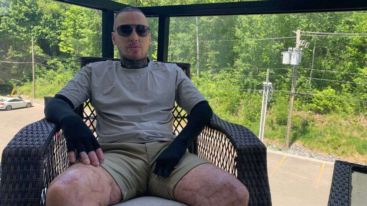 Olivier Marchand, 36 ans, fait face à une longue réadaptation après avoir été au coeur de l'explosion de l'usine Bois Ouvré, à Beauceville, le 20 septembre 2021.