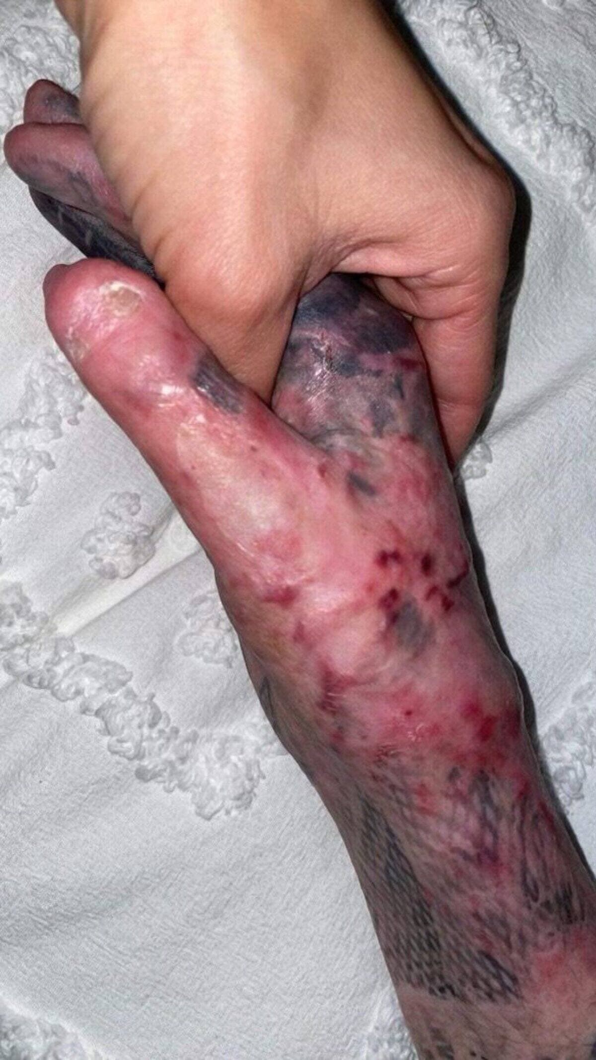 Les mains d'Olivier Marchand ont été particulièrement affectées par les flammes.