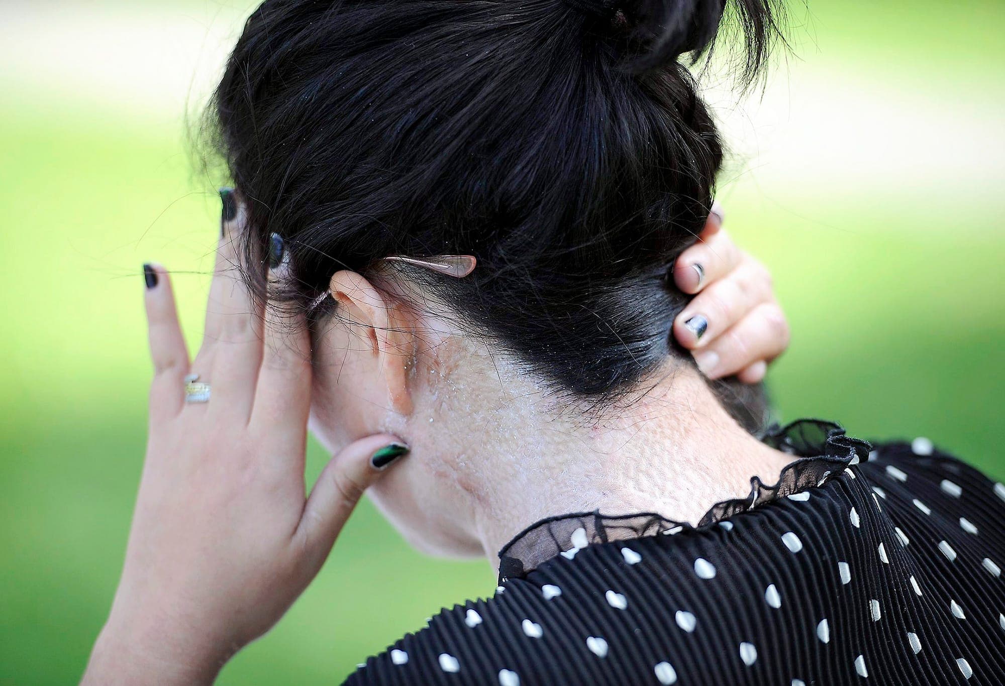 Lors d’une entrevue au Journal en août 2020, soit un an après le crime, Wiem Haj Amor avait montré des marques de brûlures infligées par son ex-conjoint Frej Haj Messaoud.