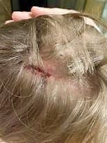 Le cuir chevelu fendu de l’homme après l’altercation.