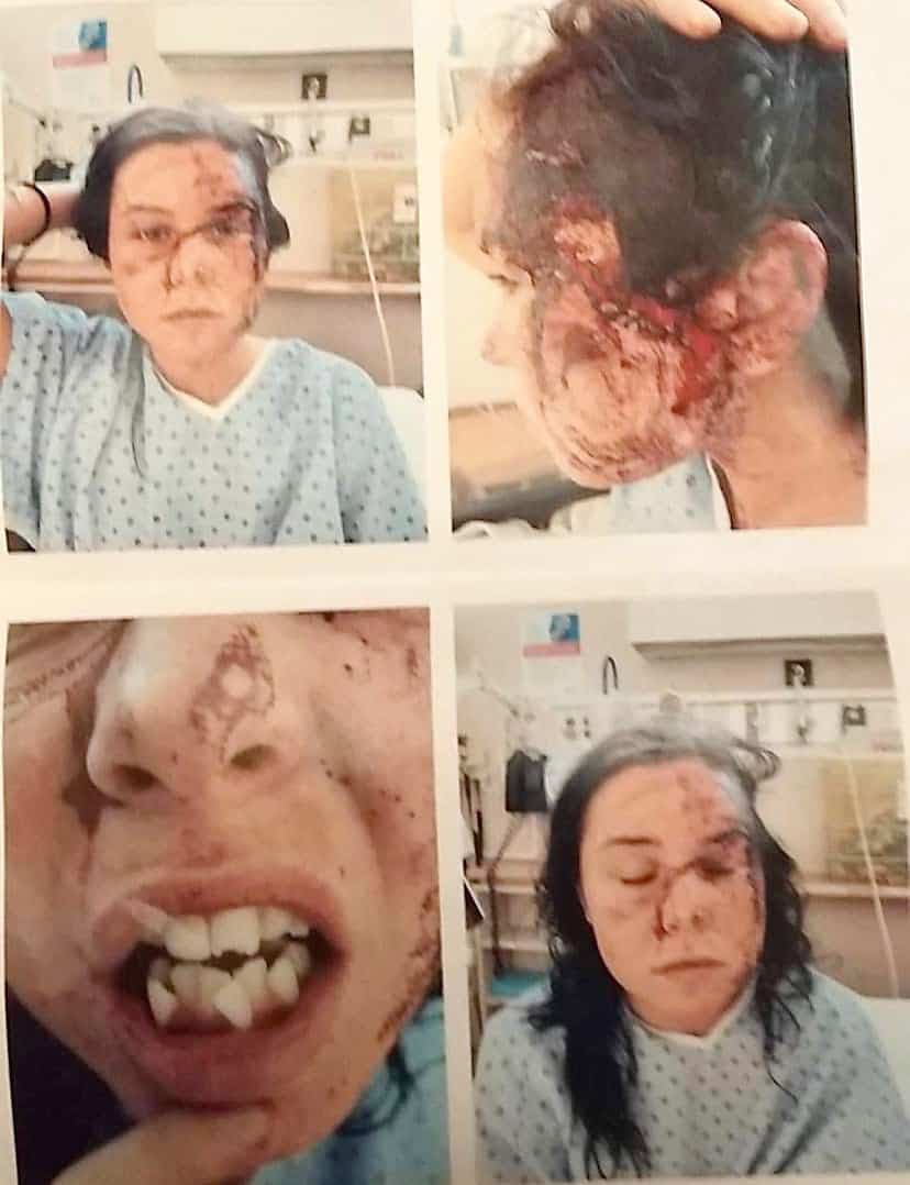 Lorsqu’elle avait été hospitalisée après un épisode de violence le 1er janvier 2020, les policiers avaient pris des photos de ses blessures : traumatisme crânien, dents cassées, poignet cassé.