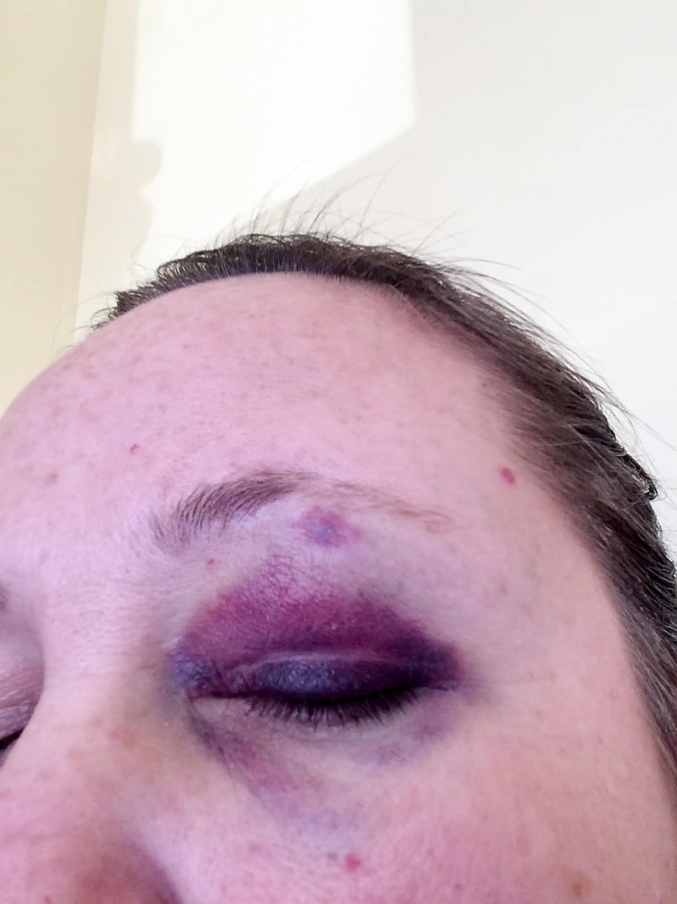 Nathalie Hébert souffre de stress post-traumatique après avoir vécu deux agressions en trois ans. La première l’a laissée avec un décollement de la rétine.