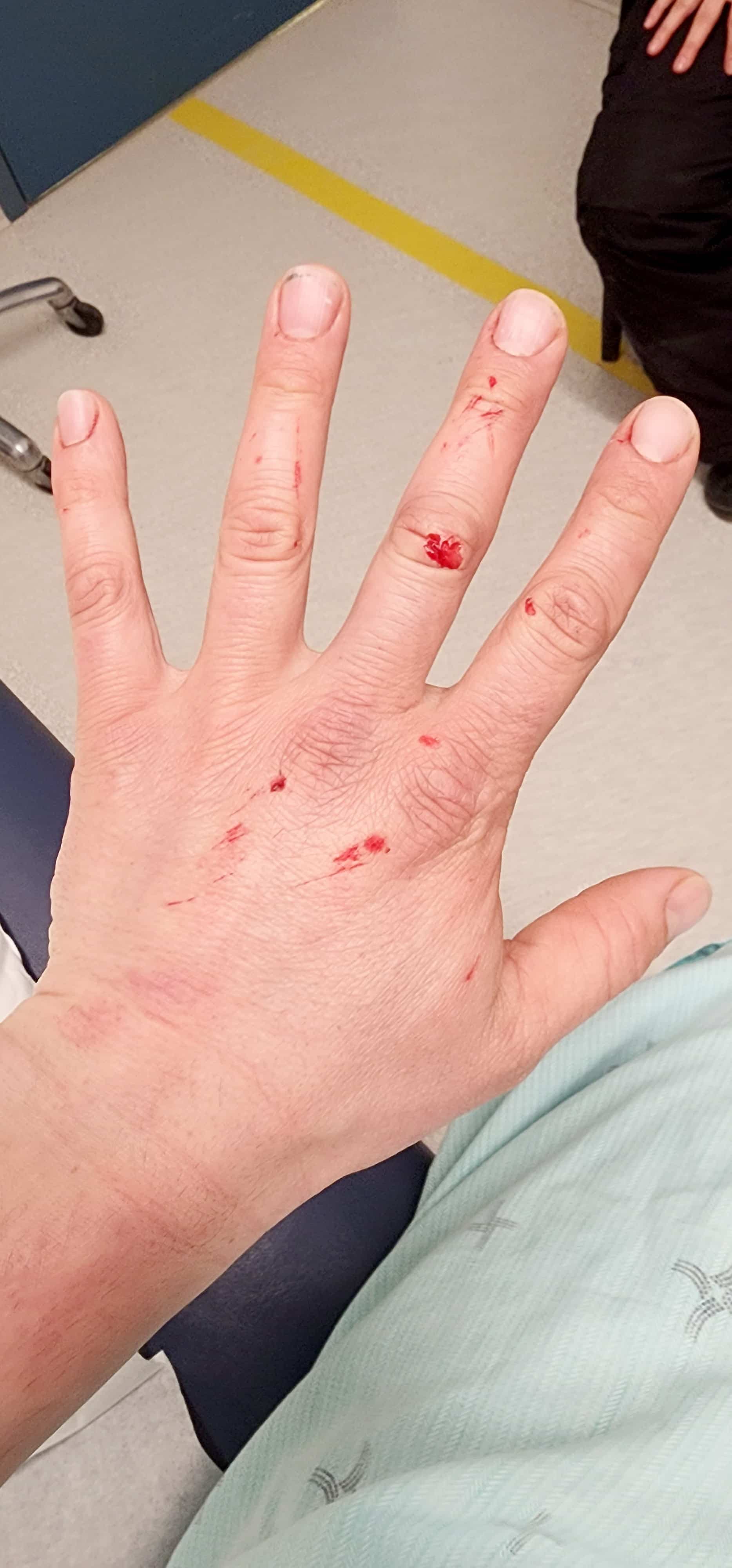 Cicatrices sur la main de Bruno Ostiguy après l'avalanche.