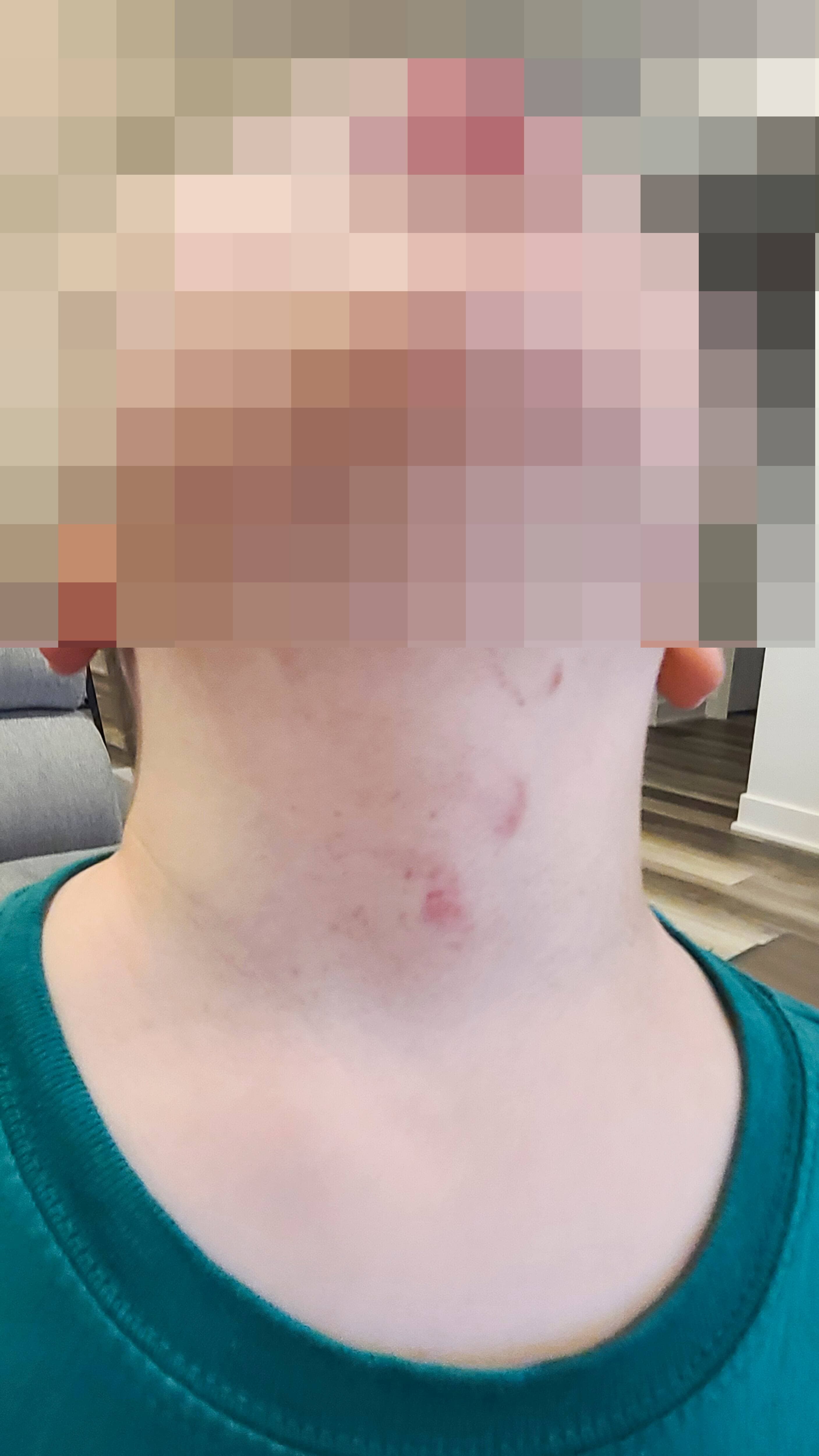 Les ecchymoses visibles sur le petit garçon âgé de 4 ans.