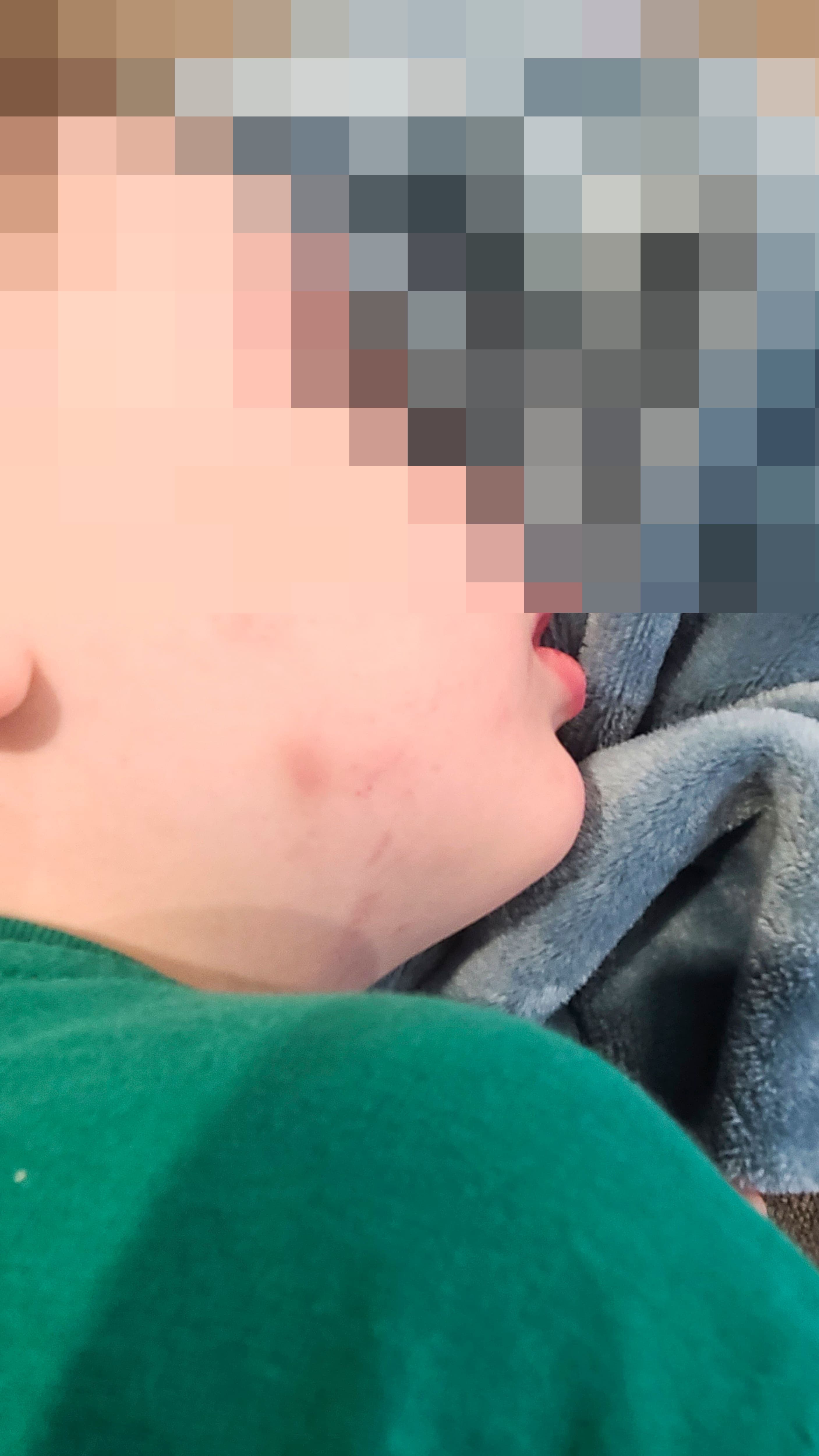 Des ecchymoses visibles sur le petit garçon de 4 ans, qui a un diagnostic probable d’autisme.