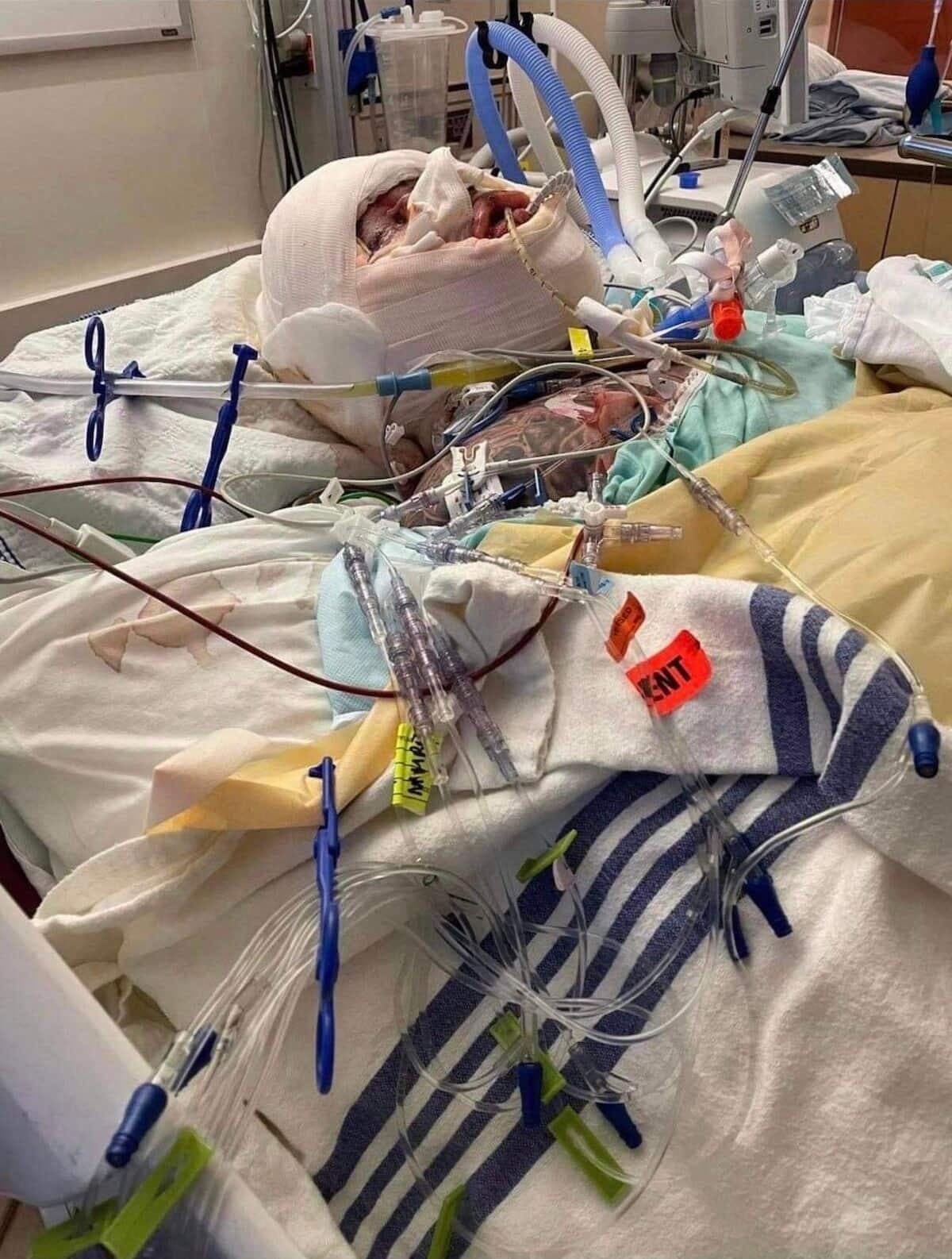 Olivier Marchand a été brûlé au troisième degré sur plus de 70% de son corps lors de l’explosion de l’usine de Bois Ouvré, à Beauceville, le 20 septembre 2021