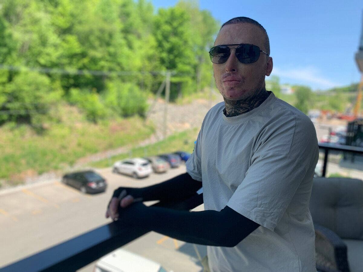 Olivier Marchand doit apprendre à vivre avec les séquelles que lui a laissées l’explosion de l’usine Bois Ouvré, il y a plus d’un an et demi.